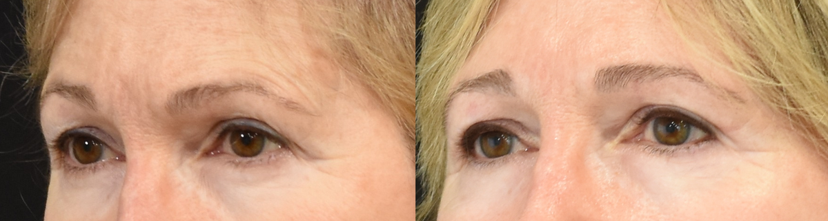 Upper Blepharoplasty_Lateral Temporal Lift_Harmon Facial Plastic Surgery_Cincinnati_Ohio.png