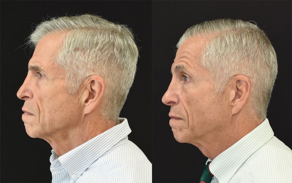 Cincinnati Cincinnati Revision Rhinoplasty Before & After - OptimizedRhinoplasty Before & After