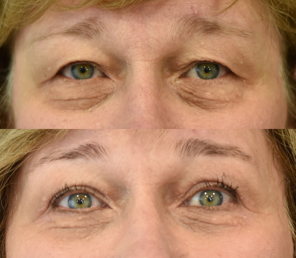 Upper Eyelid Surgery (Blepharoplasty) and Lower Eyelid Surgery (Blepharoplasty) Before & After in Cincinnati, Ohio