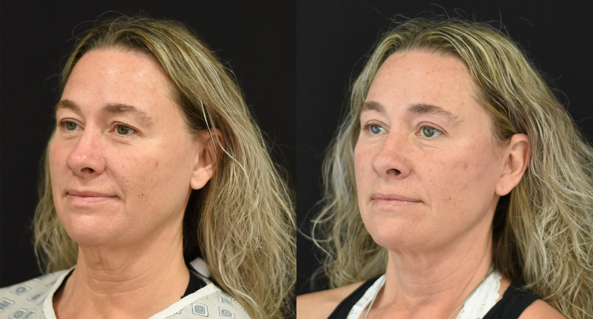 Facelift, Neck Lift, and Upper eyelid (blepharoplasty) surgery before & after image in Cincinnati, Ohio