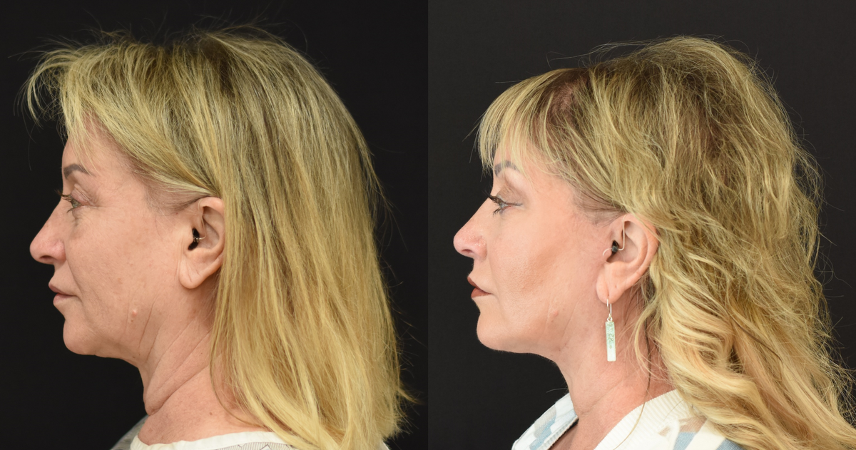 Facelift, Neck Lift, and Lip Lift Before & After in Cincinnati, Ohio
