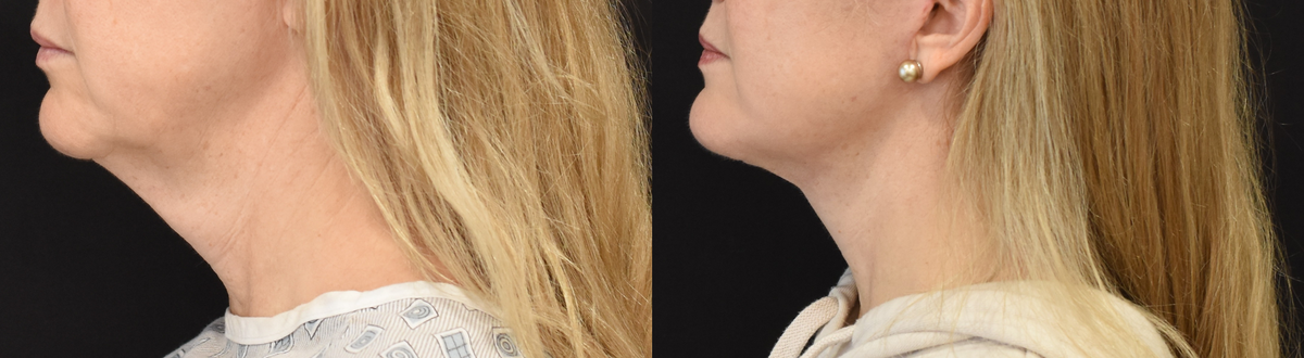 Facelift , Neck Lift Before & After in Cincinnati, Ohio