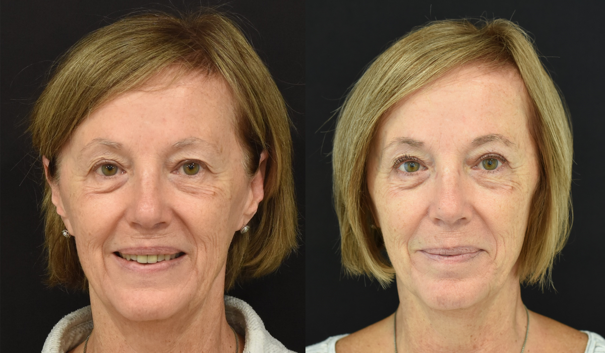 Upper blepharoplasty recipient before & after image in Cincinnati