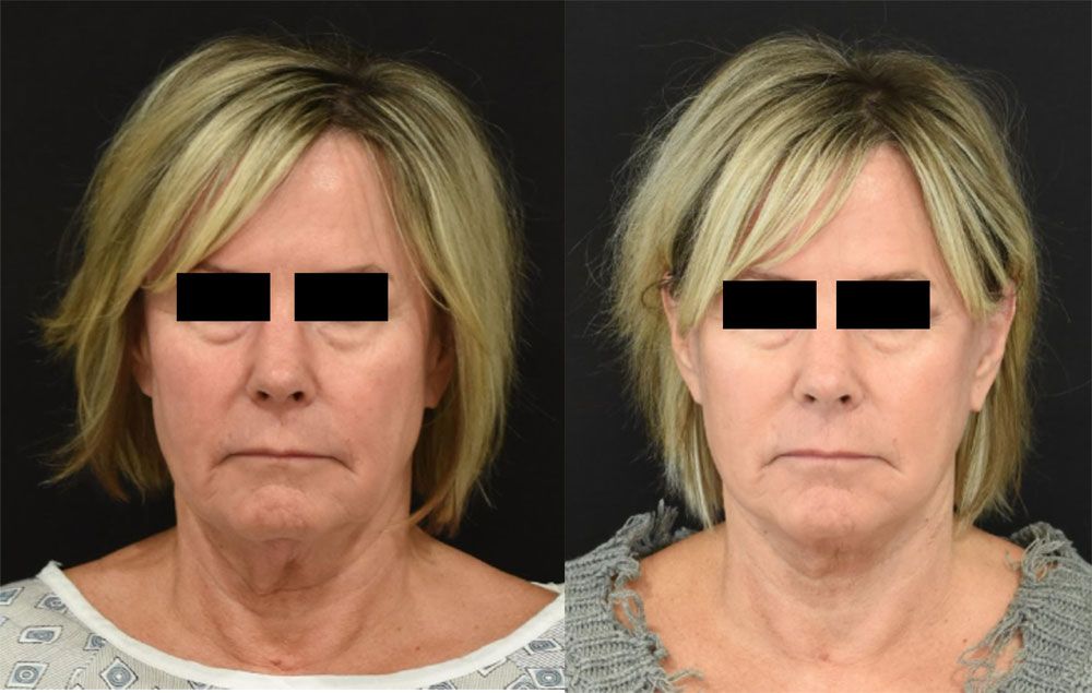 Facelift and Neck Lift in Cincinnati Before and After (Optimized)