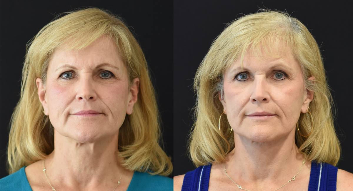 Facelift, Neck Lift, Brow Lift, Upper Eyelid (Blepharoplasty) Surgery, Lower Eyelid Skin Pinch Procedure Before & After in Cincinnati, Ohio
