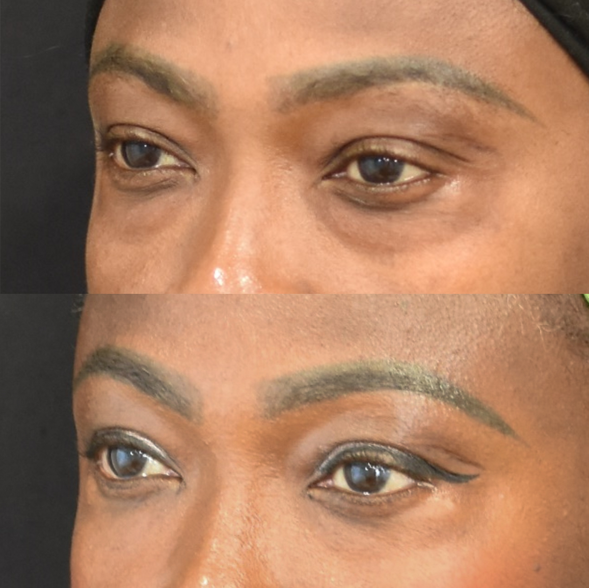 Lower Blepharoplasty Before & After in Cincinnati, Ohio