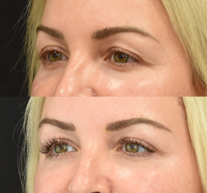 Lateral Temporal Brow Lift, Upper Eyelid (Blepharoplasty) Surgery, Lower Eyelid Skin Pinch Procedure Before & After in Cincinnati, Ohio