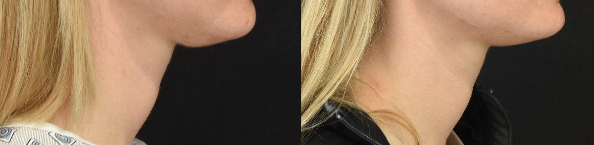 Submental liposuction recipient before & after photo Submental liposuction recipient before & after photo