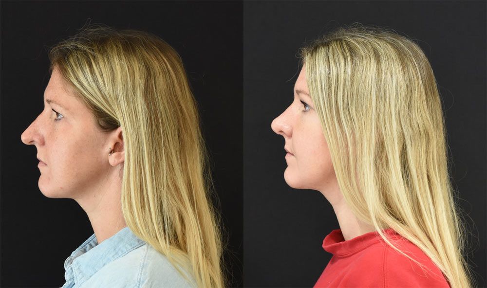 Cincinnati Revision Rhinoplasty Before and After - Left - Optimized