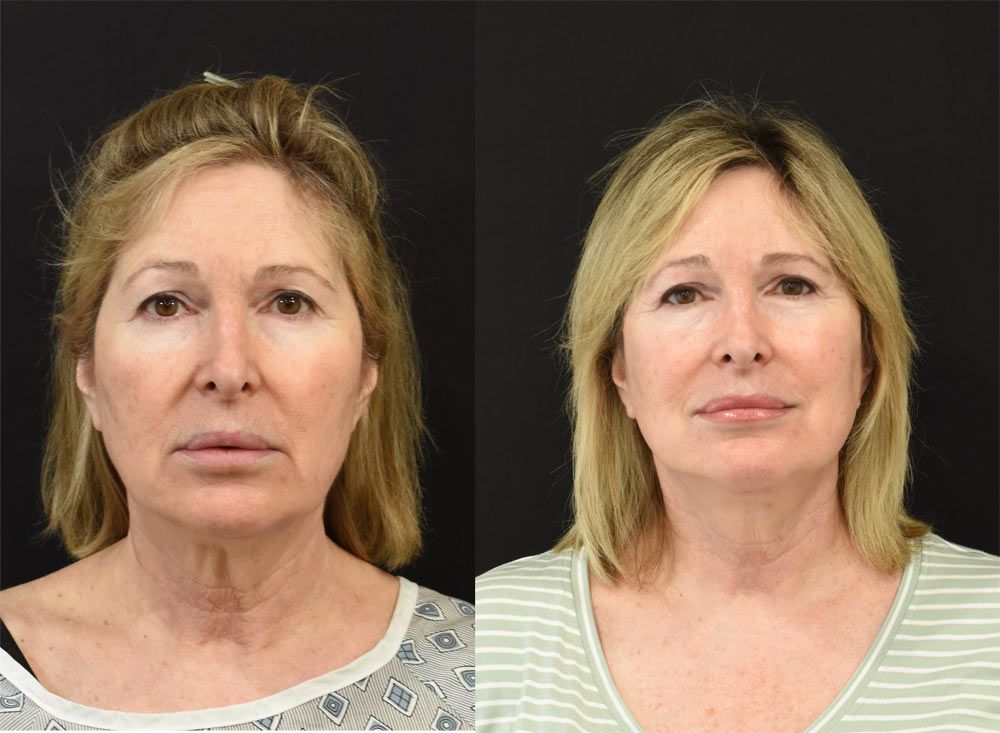 Cincinnati deep plane facelift, Cincinnati brow lift, Cincinnati neck lift recipient before & after photos Cincinnati deep plane facelift, Cincinnati brow lift, Cincinnati neck lift recipient before & after photos