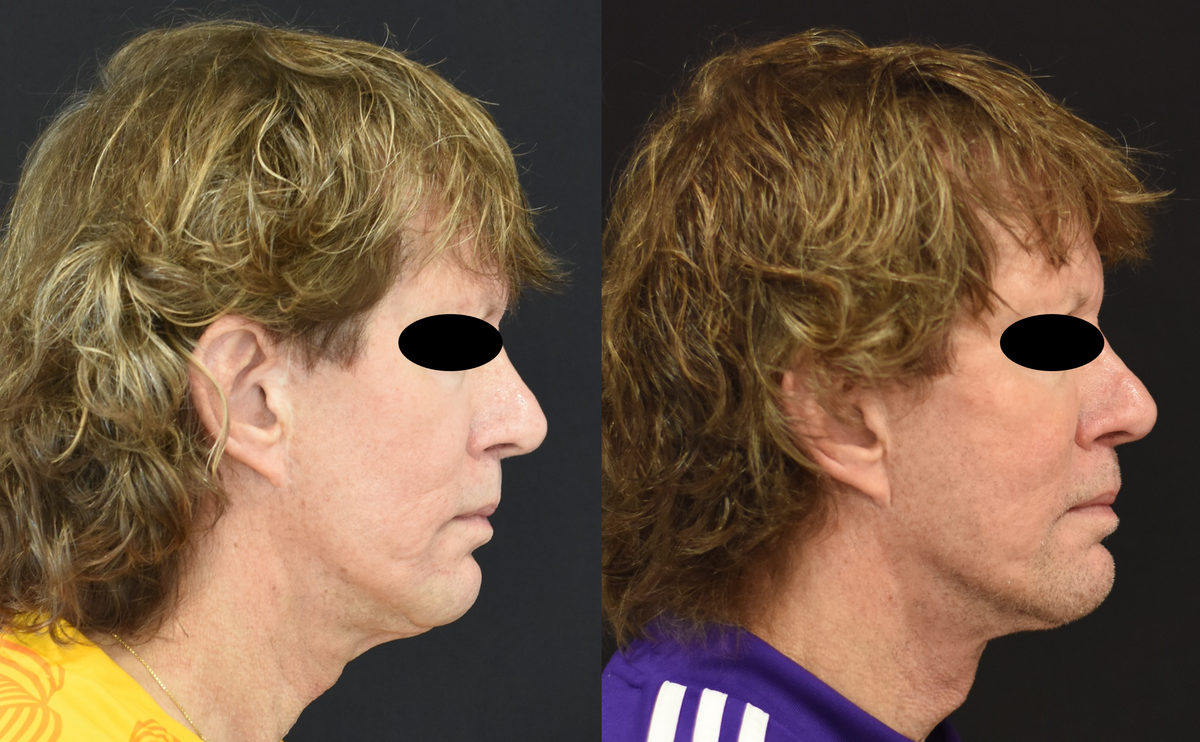 Revision Facelift, Neck Lift Before-and-After in Cincinnati, OH