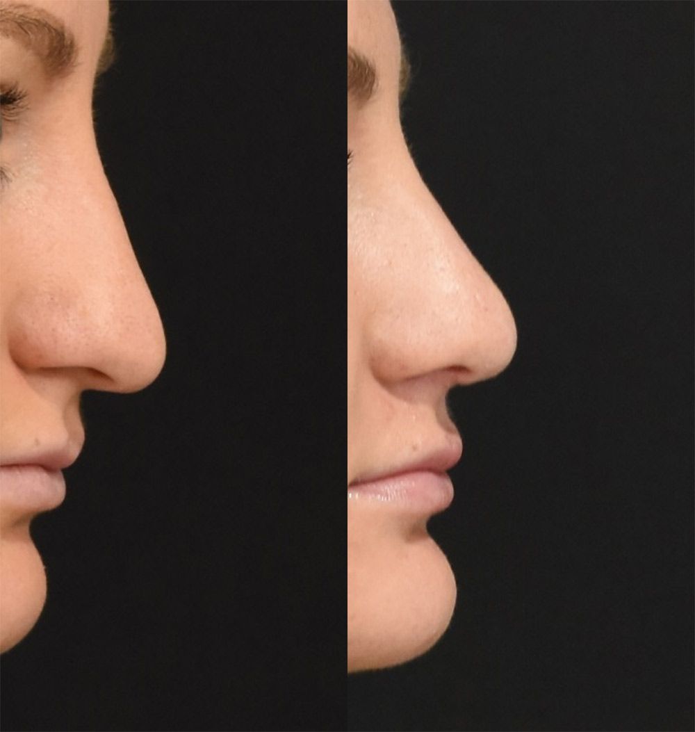 Rhinoplasty in Cincinnati