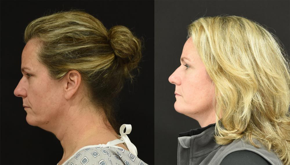 Cincinnati Brow Lift, Extended Deep Plane Facelift, and Neck Lift Before and After - Left - Optimized
