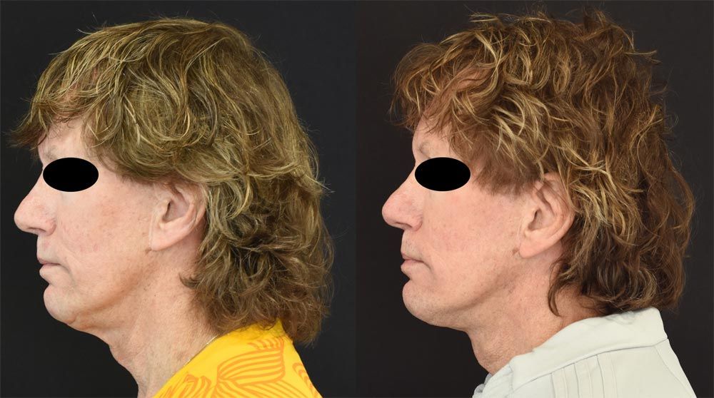 Cincinnati Revision, Neck Lift, Extended Deep Plane Facelift Before and After - Left - Optimized