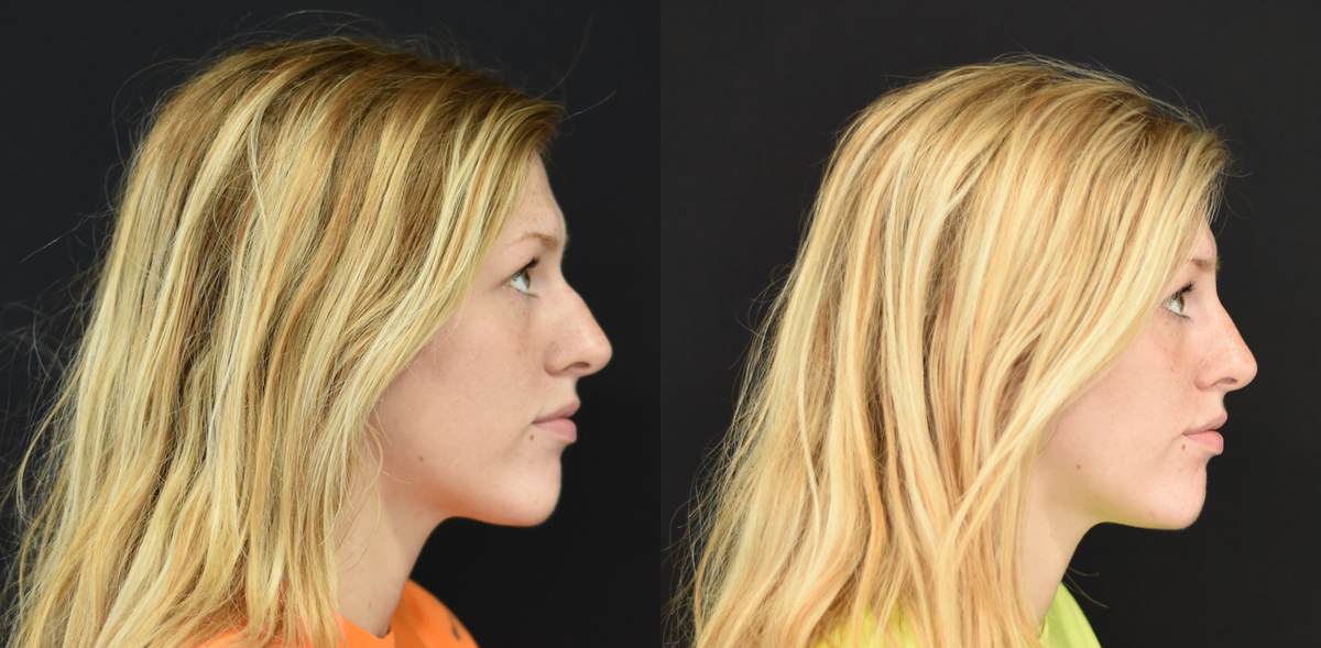 HW_Non Surgical Rhinoplasty_Side View.png