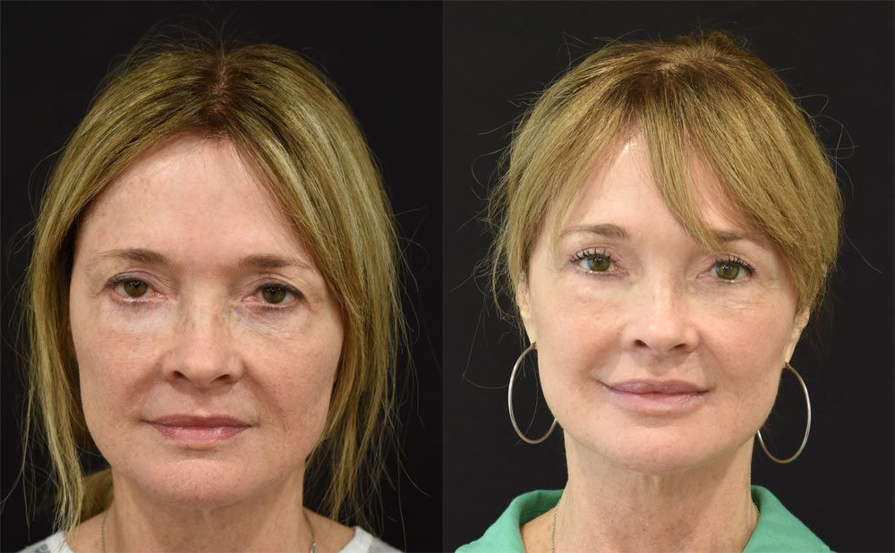 Cincinnati Revision Blepharoplasty Before & After