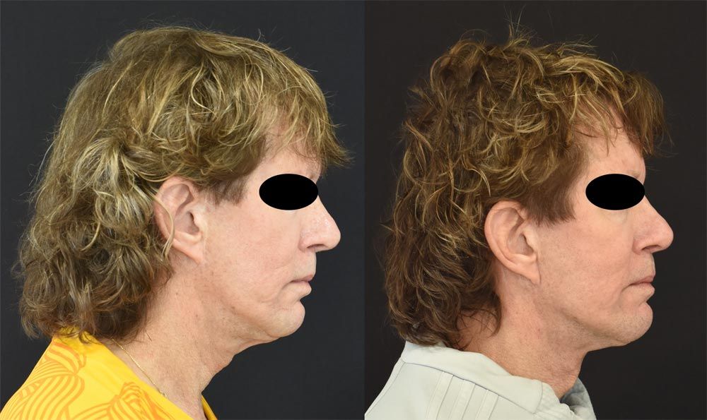 Cincinnati Revision, Neck Lift, Extended Deep Plane Facelift Before and After - Right - Optimized