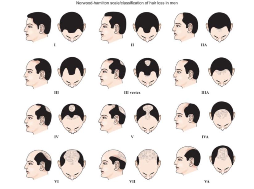 Diagram of Norwood Classification for Male Patterned Androgenic Alopecia