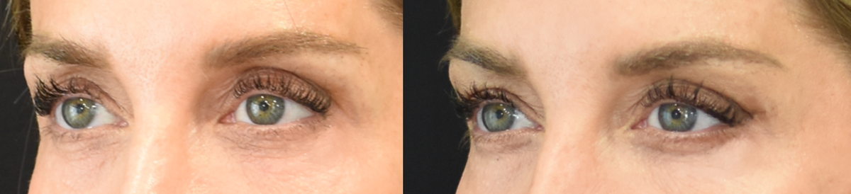 Lower Eyelid Skin Pinch Before-and-After in Cincinnati, Ohio