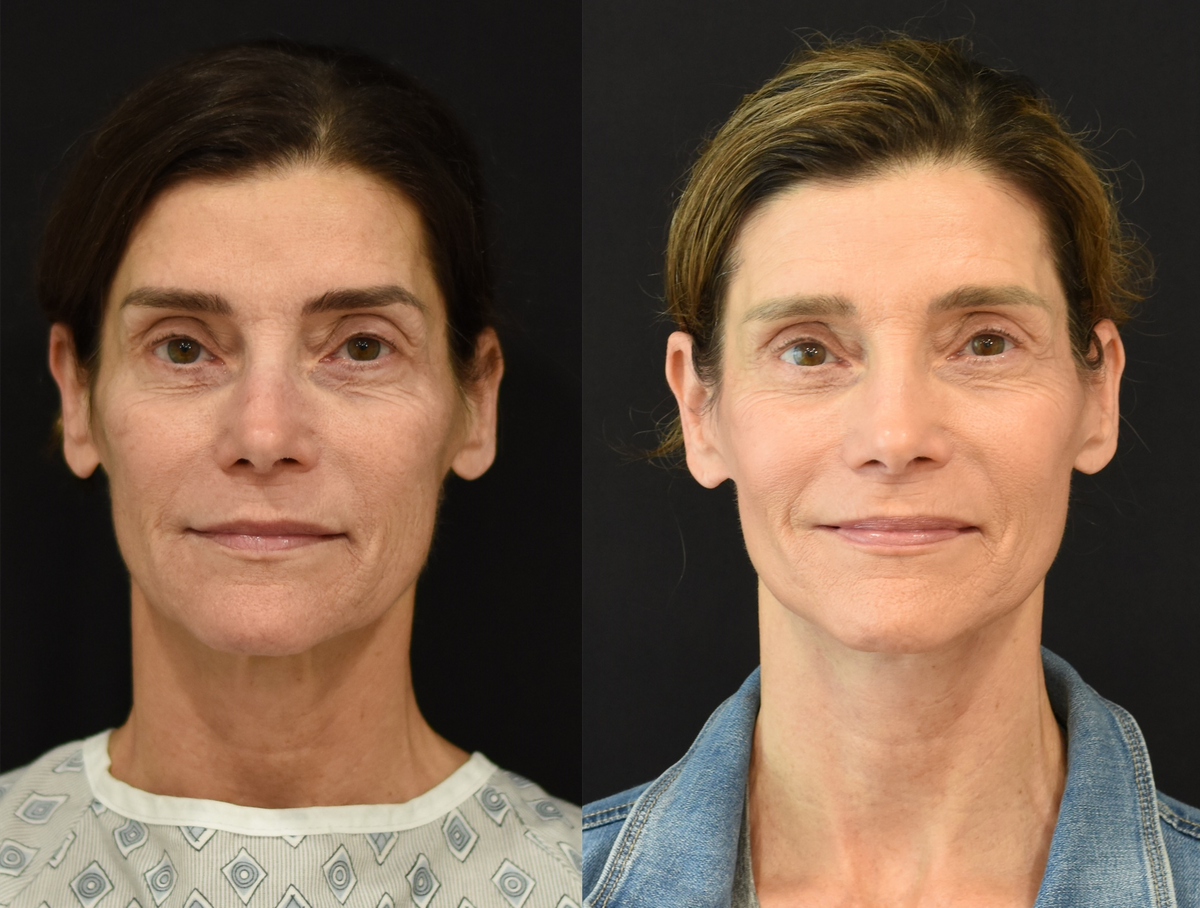Facelift, Neck Lift, Brow Lift, and Laser Resurfacing Before and After in Cincinnati, Ohio