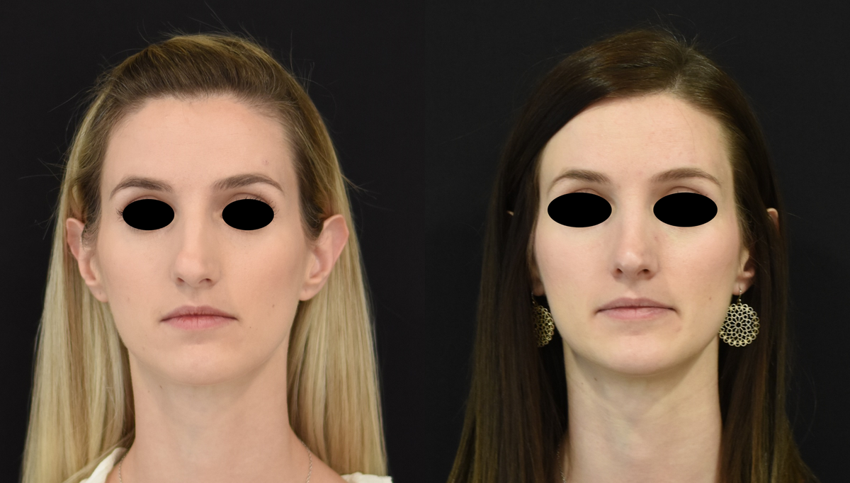 Nose Surgery (Rhinoplasty) Before & After in Cincinnati, Ohio