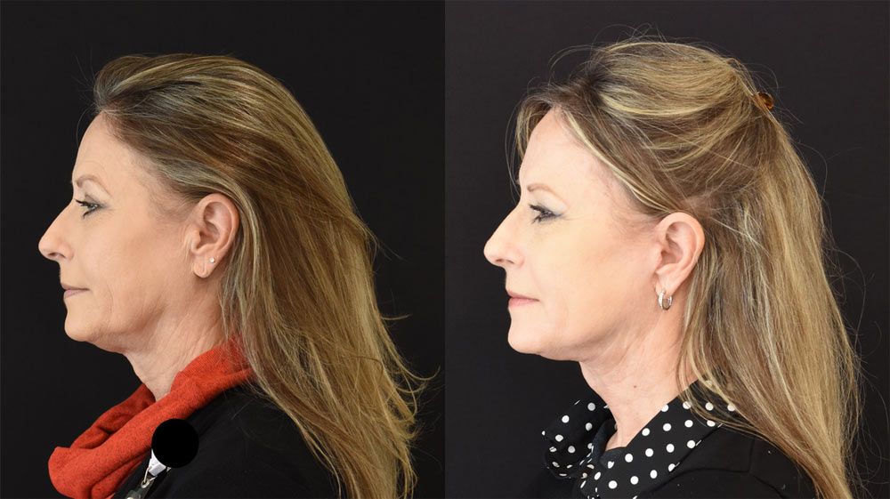 extended deep plane facelift, neck lift, brow lift (left) (optimized) extended deep plane facelift, neck lift, brow lift (left) (optimized)