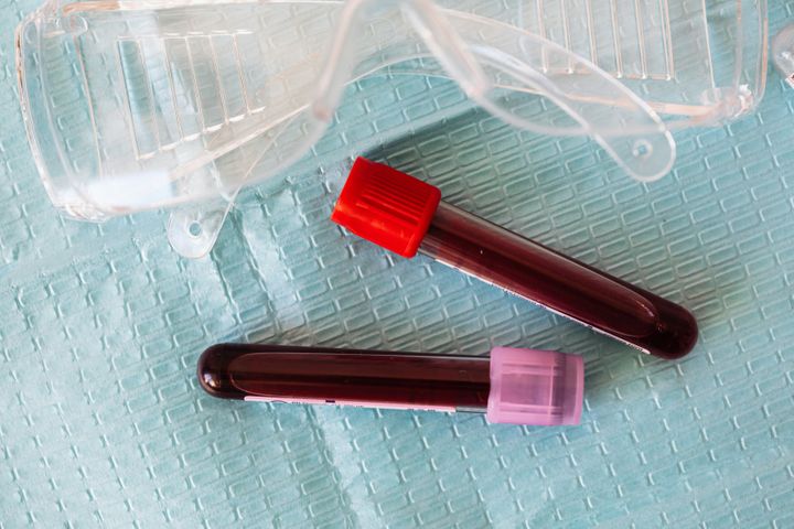 Vials of blood used in pre-operative testing for Cincinnati facial plastic surgery
