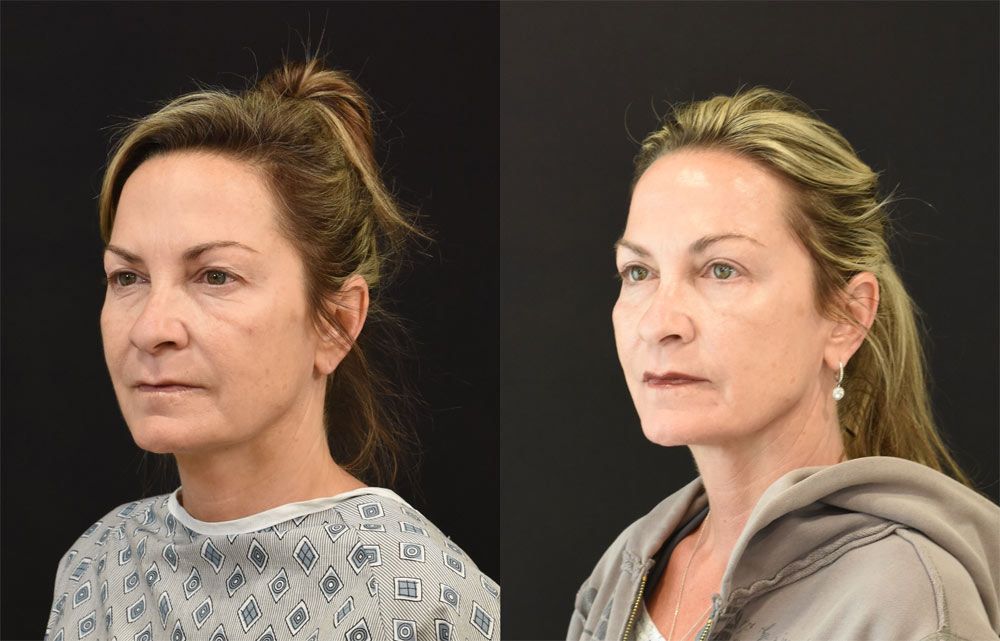 A recent Cincinnati Eyelid Surgery (blepharoplasty recipient) - Eyelid Surgery Before & After photos
