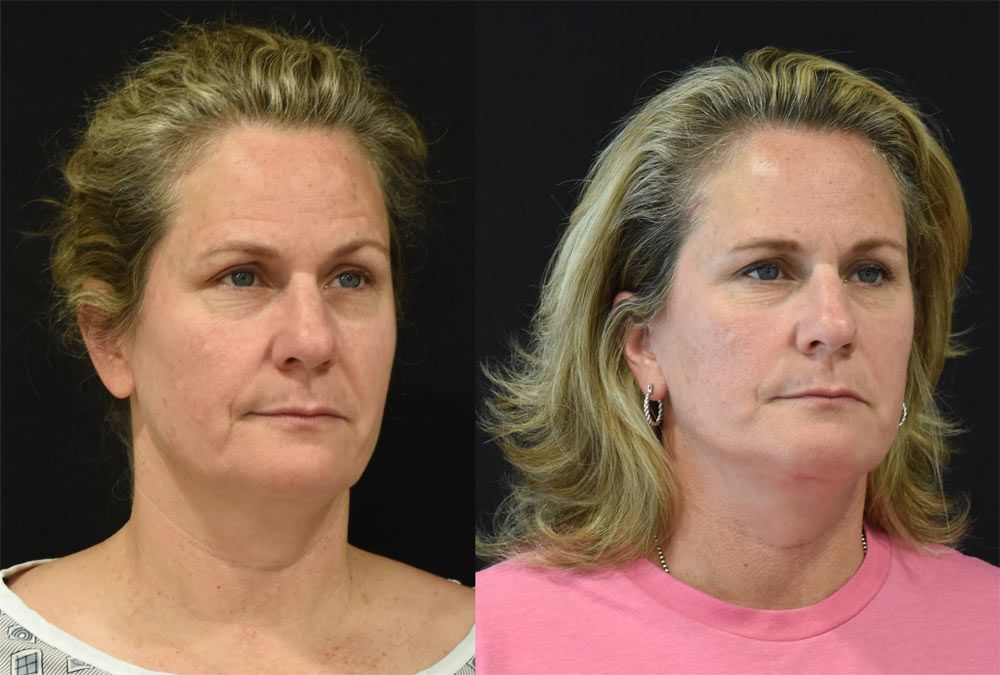 Cincinnati Facelift, neck lift, and lateral temporal brow lift recipient before & after image