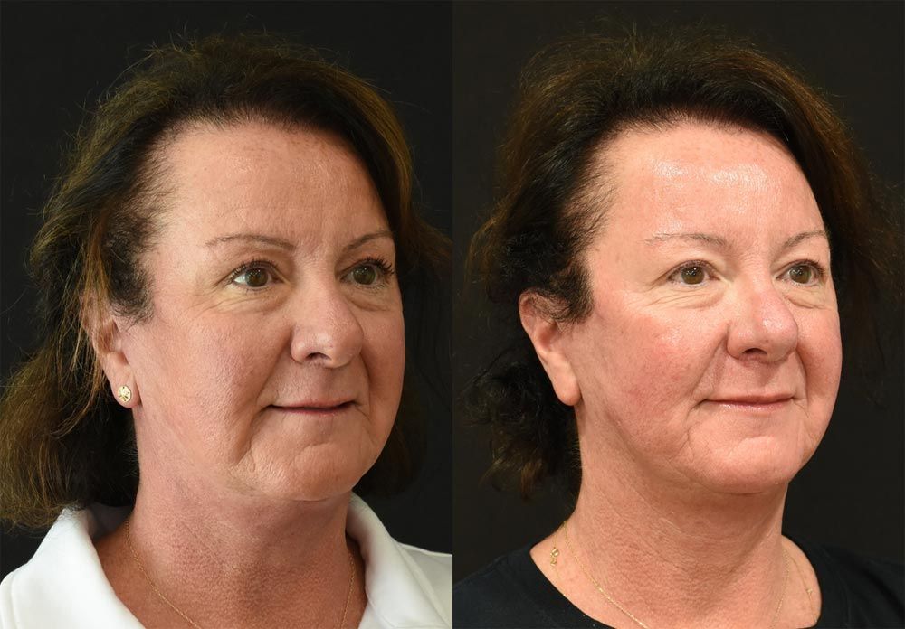 Lip Lift in Cincinnati Lip Lift in Cincinnati
