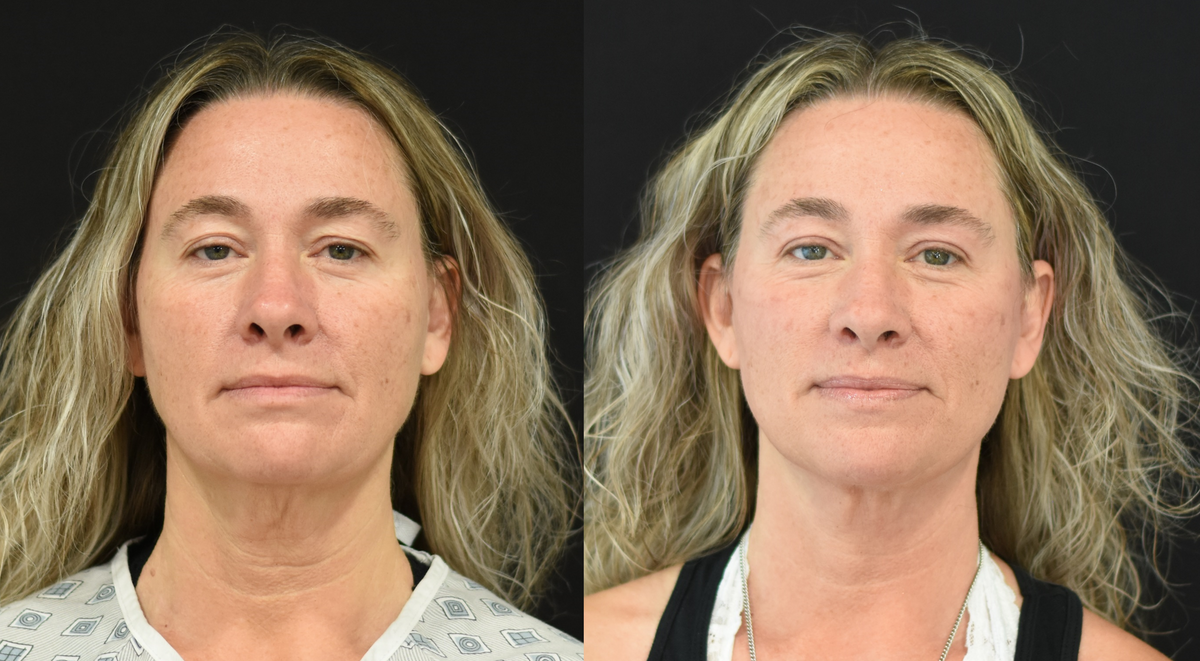Facelift, Neck Lift, and Upper eyelid (blepharoplasty) surgery before & after image in Cincinnati, Ohio