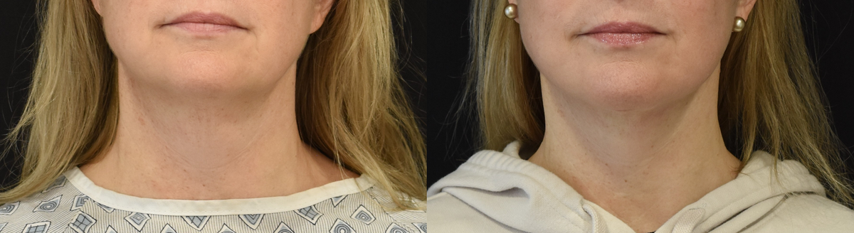 Facelift , Neck Lift Before & After in Cincinnati, Ohio