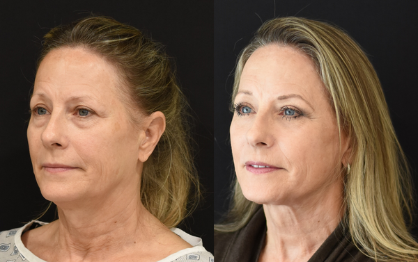 Facelift, Neck Lift, Brow Lift, and Lower Eyelid Surgery Before and After in Cincinnati, Ohio