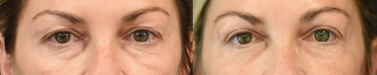 Lower eyelid (blepharoplasty) surgery, upper eyelid (blepharoplasty) surgery before & after image in Cincinnati, Ohio