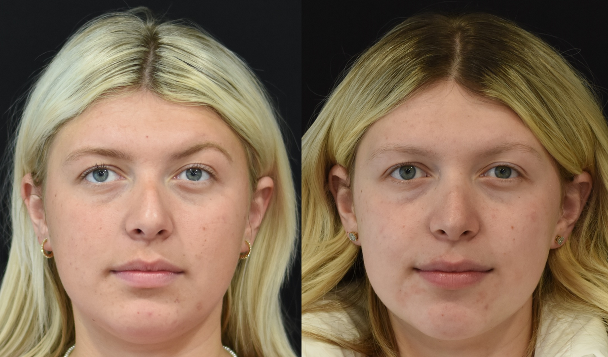 Rhinoplasty Before & After in Cincinnati, Ohio