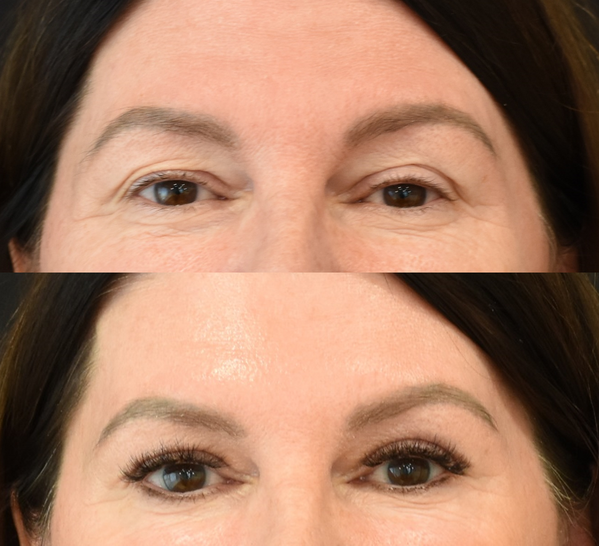 Brow Lift, Upper Eyelid Surgery (Blepharoplasty) Before & After in Cincinnati, Ohio