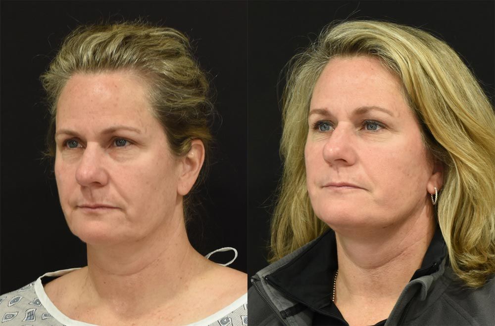 Cincinnati Brow Lift, Extended Deep Plane Facelift, and Neck Lift Before and After - Three Quarter - Optimized