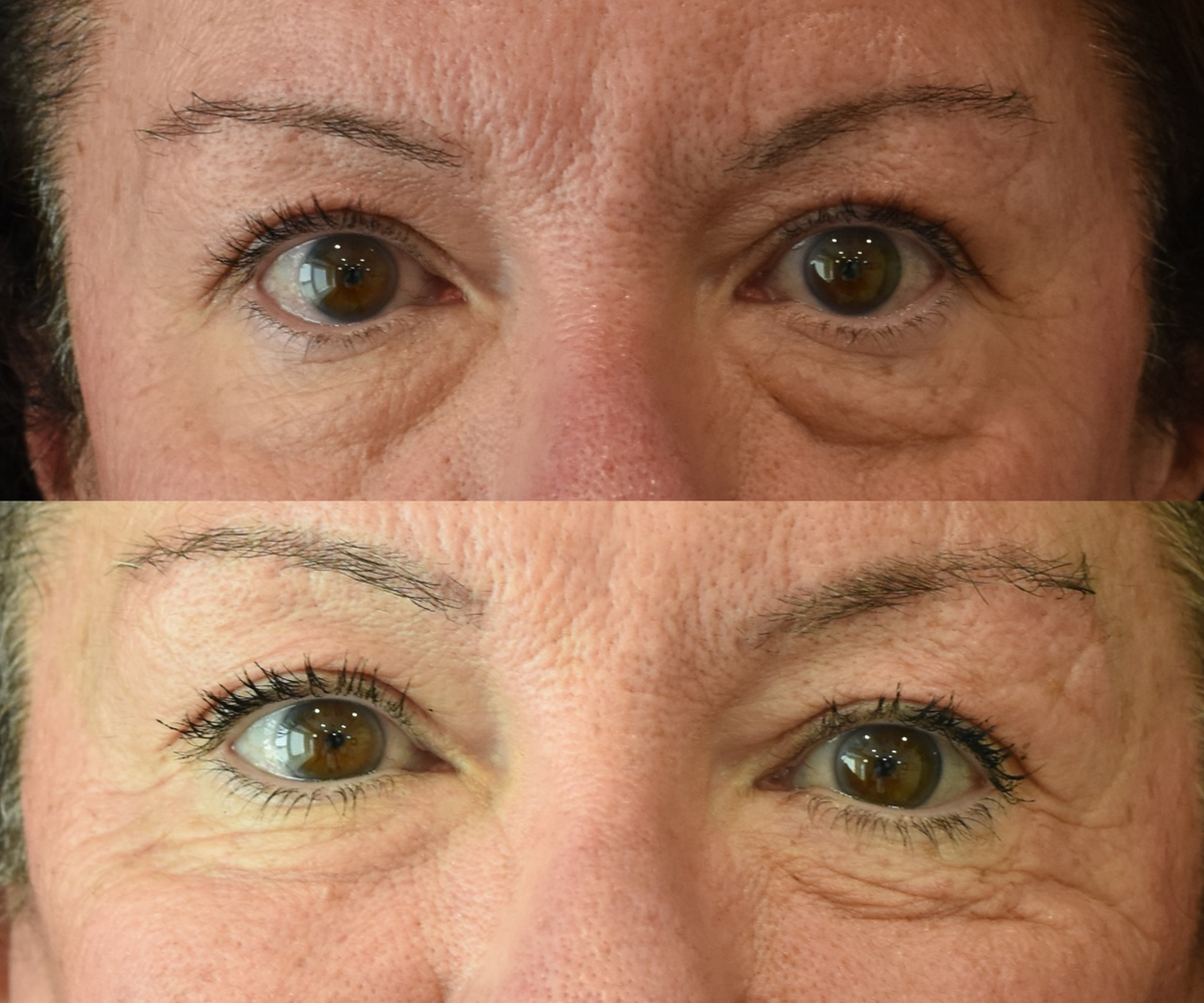 Lower Eyelid (Blepharoplasty) Surgery Before & After in Cincinnati, Ohio