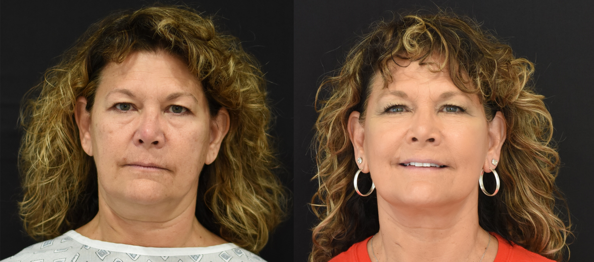 Facelift, neck lift, CO2 laser, and nano-fat grafting before & after in Cincinnati, Ohio