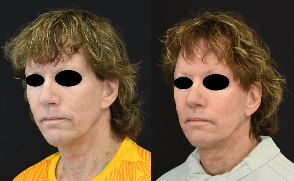 Cincinnati Revision, Neck Lift, Extended Deep Plane Facelift Before and After - Left 3/4 - Optimized