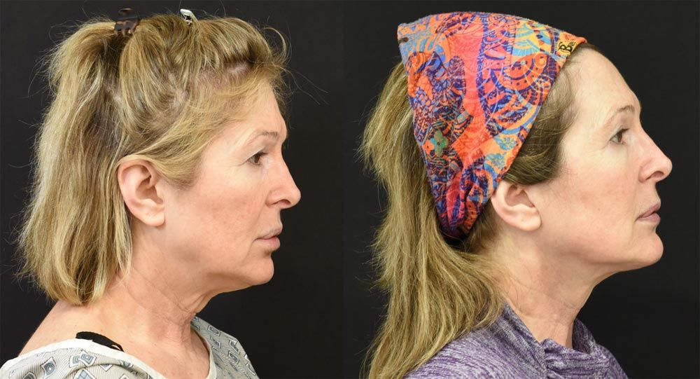 Cincinnati Extended Deep PLane Facelift, Neck Lift, Brow Lift, Eyelid Surgery Before and After - Right - Optimized Cincinnati Extended Deep PLane Facelift, Neck Lift, Brow Lift, Eyelid Surgery Before and After - Right - Optimized