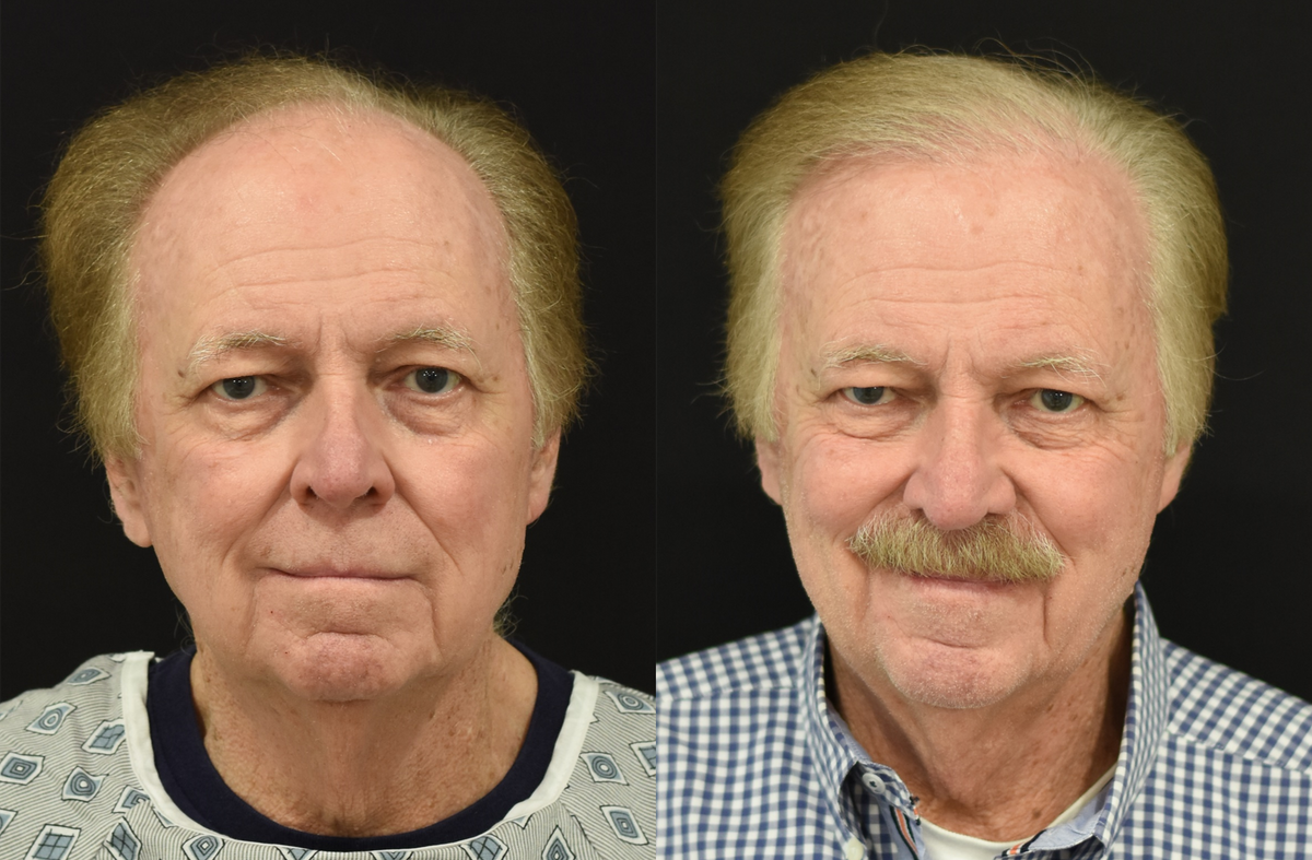 Hair Restoration Surgery Before and After in Cincinnati, Ohio