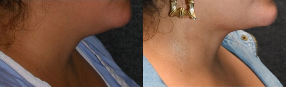 Submental liposuction recipient before & after photo