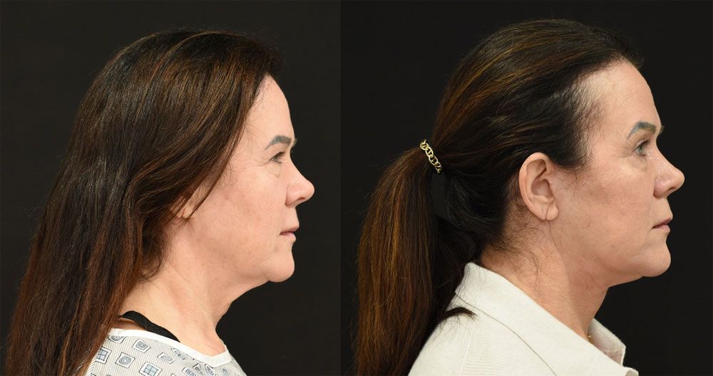 Cincinnati Extended Deep Plane Facelift, Neck Lift, Brow Lift Before and After - Right - Optimized