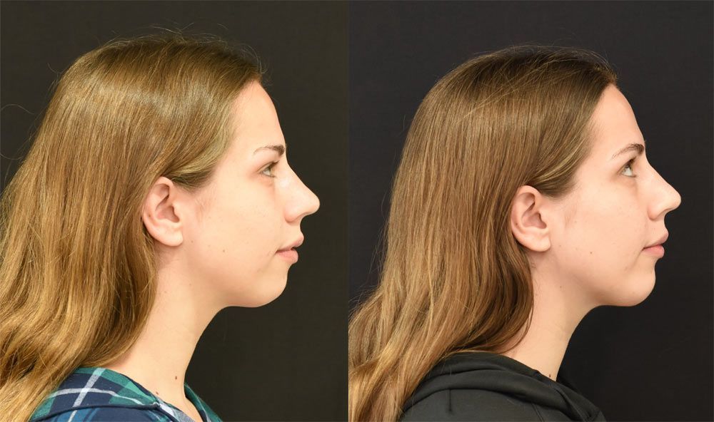 Chin Implant Before & After in Cincinnati, Ohio