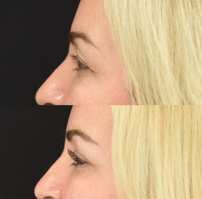 Brow Lift, Upper Eyelid (Blepharoplasty) Surgery, Lower Eyelid Skin Pinch Procedure Before & After in Cincinnati, Ohio