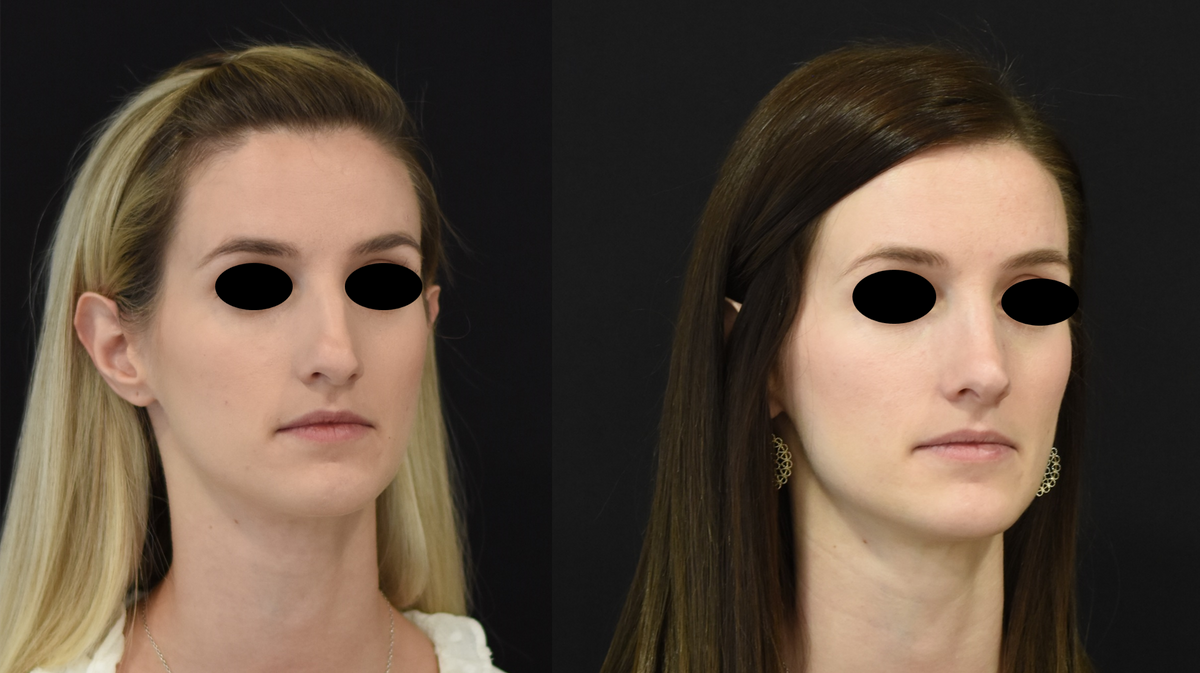 Nose Surgery (Rhinoplasty) Before & After in Cincinnati, Ohio