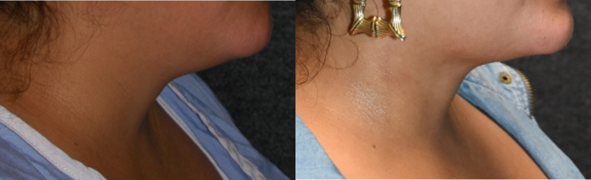 Submental liposuction recipient before & after photo Submental liposuction recipient before & after photo