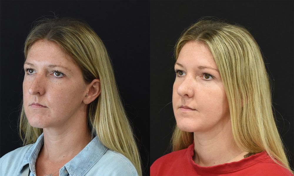 Cincinnati Revision Rhinoplasty Before and After - Three Quarter Left - Optimized
