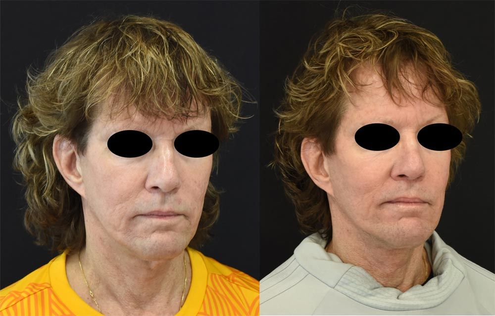 Cincinnati Revision, Neck Lift, Extended Deep Plane Facelift Before and After - Right 3/4 - Optimized